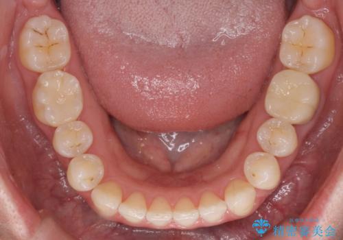 [ 歯並びと虫歯治療 ]  矯正治療とセラミック治療の包括治療の治療後