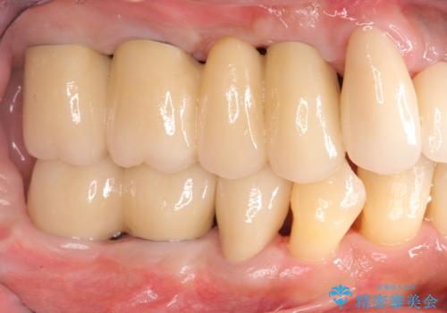 インプラント・ブリッジ補綴を含む、歯周病全顎治療の治療後