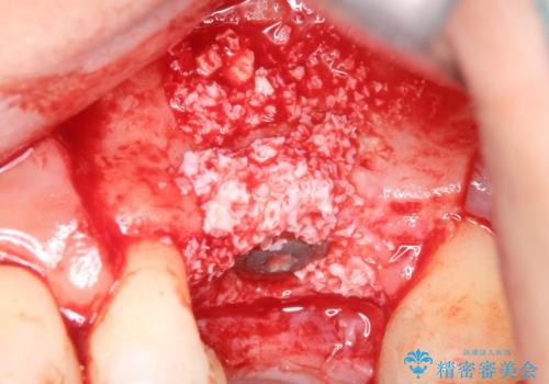 予後の悪い歯を抜歯 インプラントでの治療の治療後