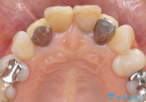 黒ずんだ見栄えの悪い前歯をきれいにしたいの治療前