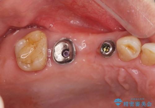 失った奥歯を、インプラント治療で機能回復の治療中