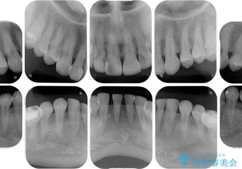 前歯の変色と隙間を治したい 前歯の審美歯科治療の治療前