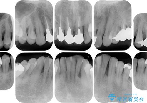 変色した前歯をきれいにしたい　部分矯正を併用した前歯の審美歯科治療の治療前