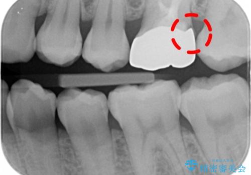 不適合な被せ物 ジルコニアクラウンでの再治療の治療前