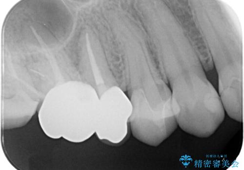 【セラミックインレー】フロスを通すと血が出て臭うの治療後
