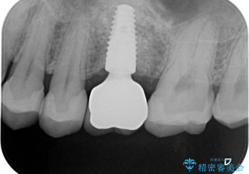 予後の悪い歯を抜歯 インプラントでの治療の治療後