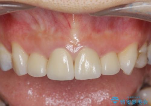黒ずんだ見栄えの悪い前歯をきれいにしたいの治療後