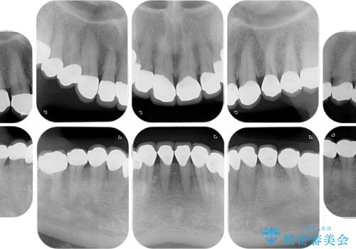 前歯の変色と隙間を治したい 前歯の審美歯科治療の治療後
