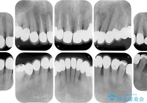 変色した前歯をきれいにしたい　部分矯正を併用した前歯の審美歯科治療の治療後