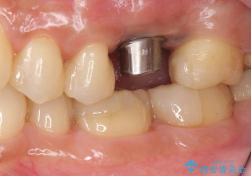 予後の悪い歯を抜歯 インプラントでの治療の治療中