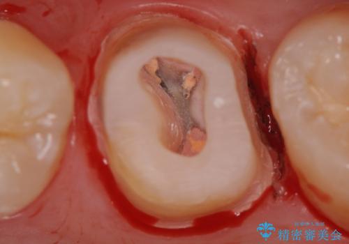 不適合な被せ物 ジルコニアクラウンでの再治療の治療中