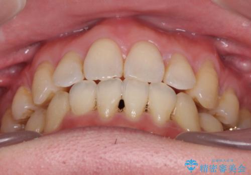 出っ歯をしっかり引っ込めたいの治療後