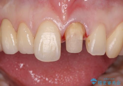 前歯を綺麗にしたい ジルコニアクラウンでの治療の治療中