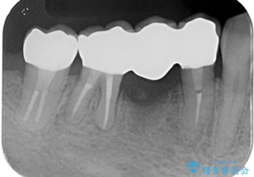 被せ物がとれた オールセラミックによるブリッジ治療の治療後