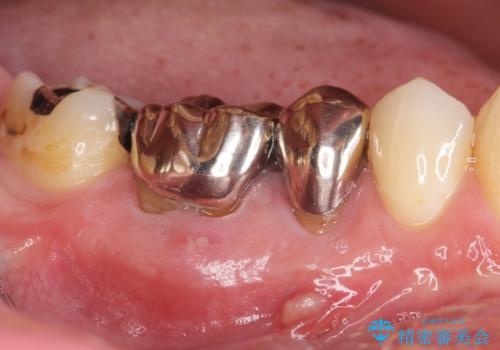 違和感のある銀歯の治療の症例 治療前