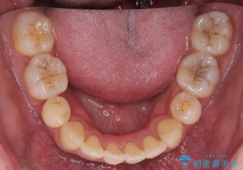 出っ歯をしっかり引っ込めたいの治療後