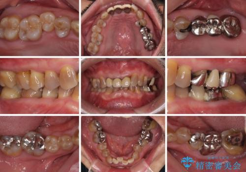 変色した前歯をきれいにしたい 部分矯正を併用した前歯の審美歯科治療の治療前