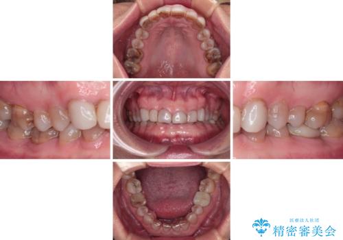 前歯の変色と隙間を治したい 前歯の審美歯科治療の治療前