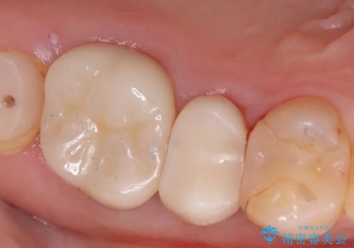 【セラミックインレー】フロスを通すと血が出て臭うの治療前