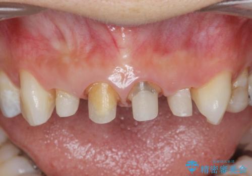 黒ずんだ見栄えの悪い前歯をきれいにしたいの治療中