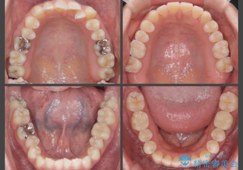 [ 歯並びと虫歯治療 ]  矯正治療とセラミック治療の包括治療