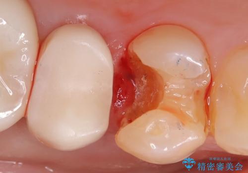 【セラミックインレー】フロスを通すと血が出て臭うの治療中