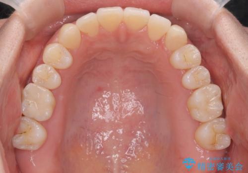 [ 歯並びと虫歯治療 ]  矯正治療とセラミック治療の包括治療の治療後
