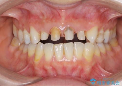 黒ずんだ見栄えの悪い前歯をきれいにしたいの治療中