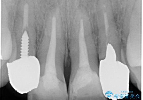 黒ずんだ見栄えの悪い前歯をきれいにしたいの治療前