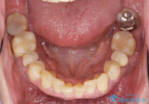 インプラント・ブリッジ補綴を含む、歯周病全顎治療の治療前