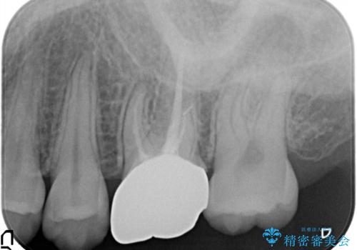 不適合な被せ物 ジルコニアクラウンでの再治療の治療前