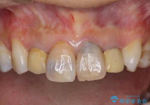 黒ずんだ見栄えの悪い前歯をきれいにしたいの治療前