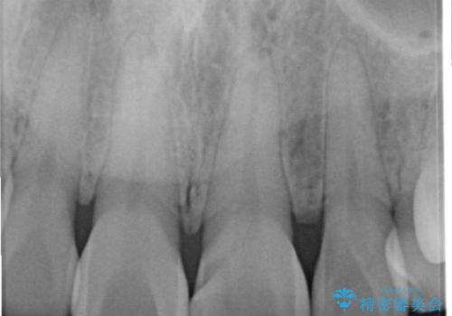 【変色歯】コンポジットレジンからセラミックへの治療前