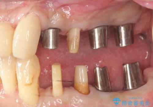 インプラント・ブリッジ補綴を含む、歯周病全顎治療の治療中