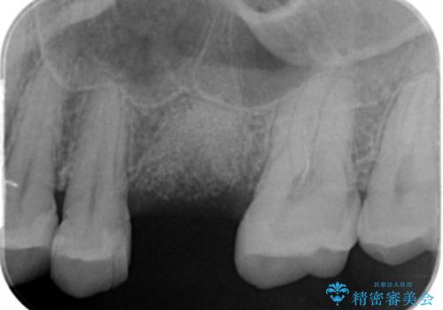 予後の悪い歯を抜歯 インプラントでの治療の治療中