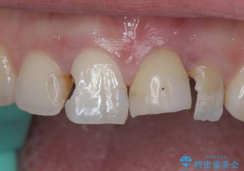 [ セラミック治療 ]  前歯の変色をきれいにしたいの治療中