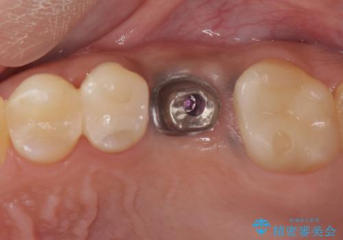 予後の悪い歯を抜歯 インプラントでの治療の治療中