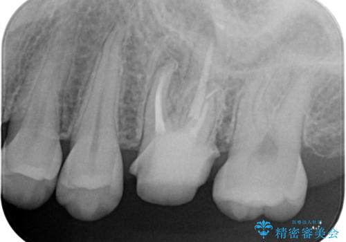 不適合な被せ物 ジルコニアクラウンでの再治療の治療中