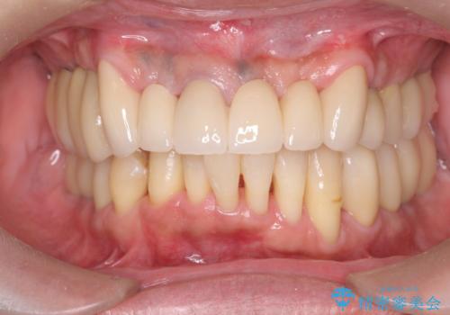 インプラント・ブリッジ補綴を含む、歯周病全顎治療の症例 治療後