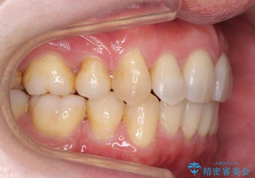 出っ歯をしっかり引っ込めたいの治療後