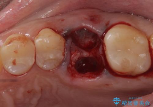 予後の悪い歯を抜歯 インプラントでの治療の治療前