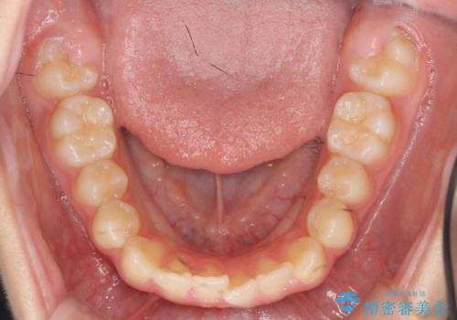 [ 前歯のねじれ改善 ]   中学生に行う早期マウスピース矯正治療の治療前