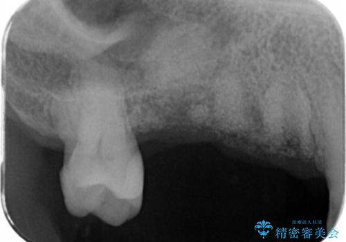 失った奥歯を、インプラント治療で機能回復の治療前