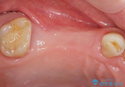 失った奥歯を、インプラント治療で機能回復の治療前