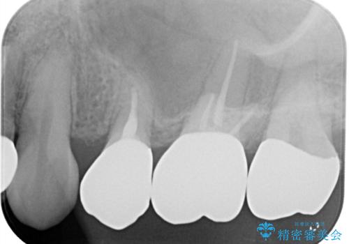 二次う蝕が心配の治療後