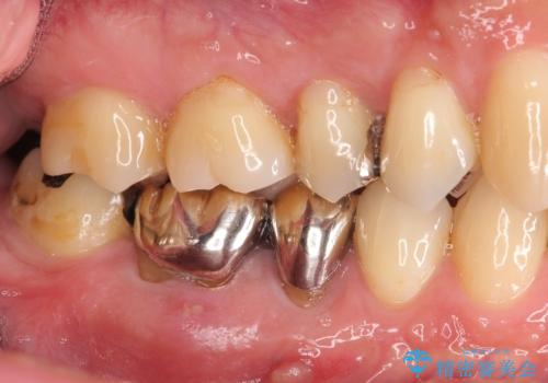 違和感のある銀歯の治療の治療前