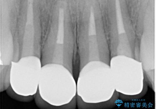 黒ずんだ見栄えの悪い前歯をきれいにしたいの治療後