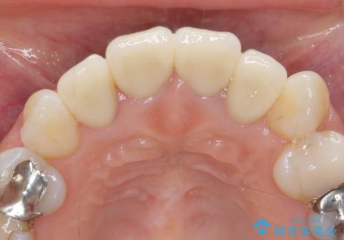 黒ずんだ見栄えの悪い前歯をきれいにしたいの治療後