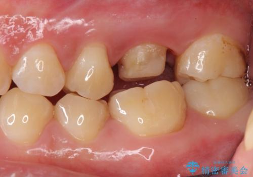 不適合な被せ物 ジルコニアクラウンでの再治療の治療中