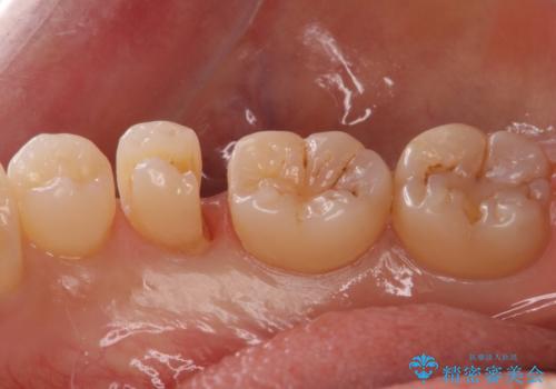 歯と歯の間の虫歯　セラミックインレーでの修復処置の治療中